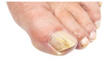 Foot and nail mycosis